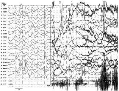Case report: A young man with non-rapid eye movement parasomnias in a KCNT1-related epilepsy family